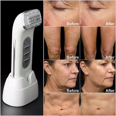 Real Remove Wrinkles Dot Matrix Facial Radio Frequency Lifting Face