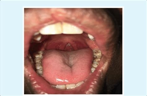 Absent Uvula In Oral Cavity Parapharyngeal Arch Visible Download