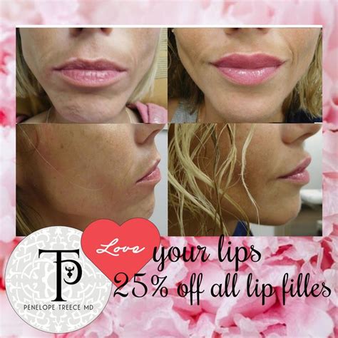 MUAH Photos Are Worth A Thousand Kisses All Lip Fillers Are Off Through Valentine S Day