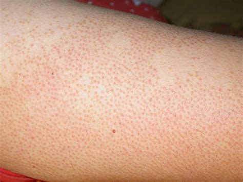 Freckles On Legs 5 Causes And 10 Remedies