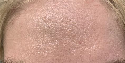 Advice For Healing Peau Dorange Skin Due To Illness This Is My