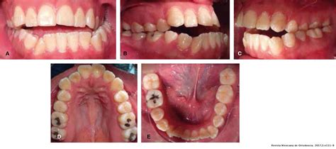 Surgical Orthodontic Treatment In A Skeletal Class Iii Patient With