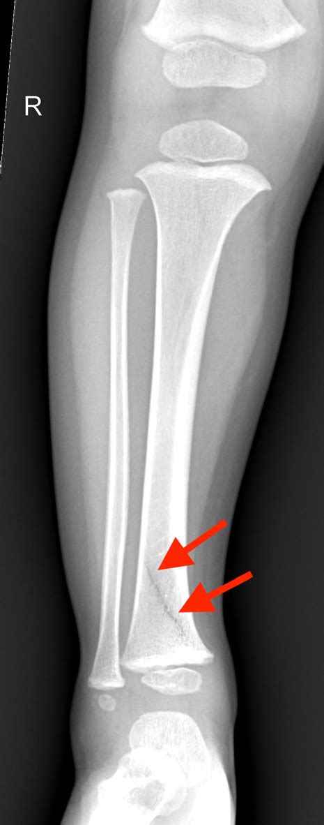 Broken Shin Bone In A Toddler Toddler Tibia Fracture Texas Children