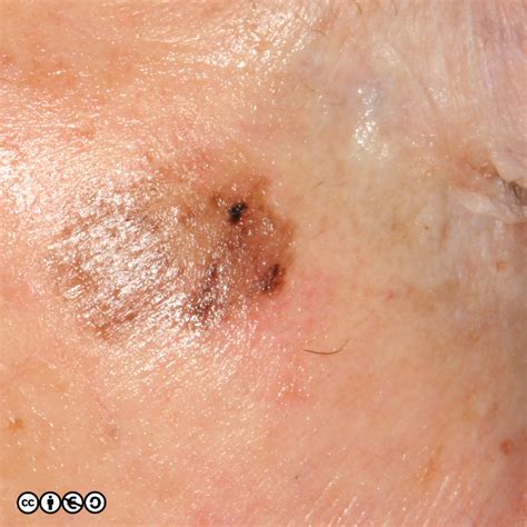Melanoma Skin Cancer 909