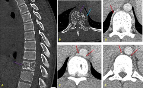 Ct Of The Thoracic Spine Without And With Contrast Unenhanced