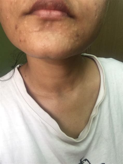 What Are These Bumpsrashes On My Chin They Are Present Only On My