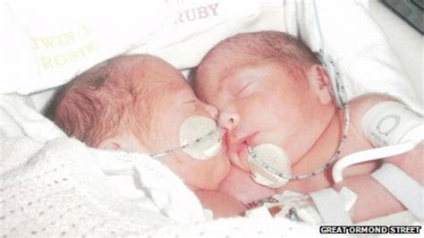 Conjoined Twins Rosie And Ruby Formosa Separated Bbc News