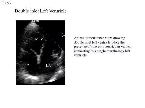 Ppt Double Inlet Left Ventricle Powerpoint Presentation Free