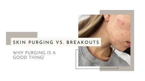 Learn More About Skin Purging Vs Breakouts Blog Atalo Aesthetics