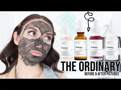 How do you get rid of fordyce spots? THE ORDINARY SKINCARE - How To Get Rid Of ACNE, ACNE SCARS ...