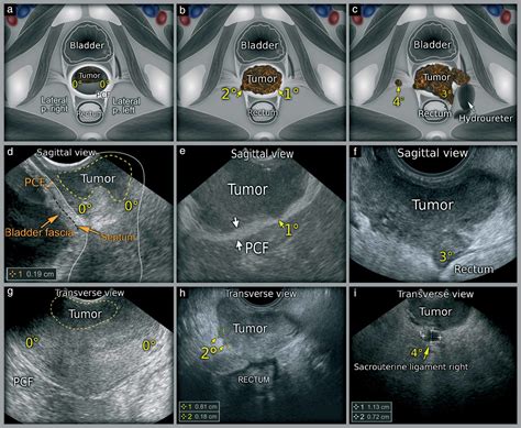 Ultrasound Scanning Of The Pelvis And Abdomen For Staging Of