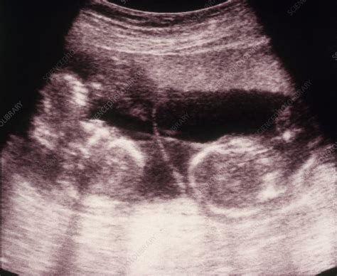 Ultrasound Of Twins Stock Image C0047390 Science Photo Library