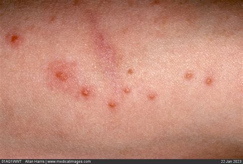 Stock Image Dermatology Insect Bites Multiple Small Red Raised Spots
