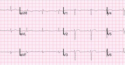Dr Smiths Ecg Blog Pseudonormalization Of Wellens Waves