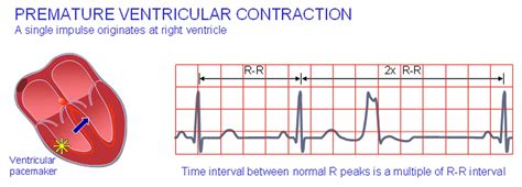 Premature Ventricular Contractions Pvcs Animation Pre