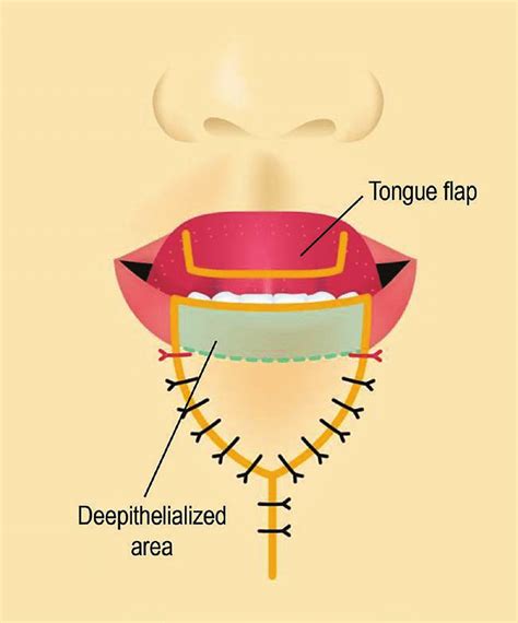 Operative Technique Using A Deepithelialized V Y Flap And Tongue Flap