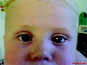 Unilateral Fixed Dilated Pupil In A Well Child Archives Of Disease In