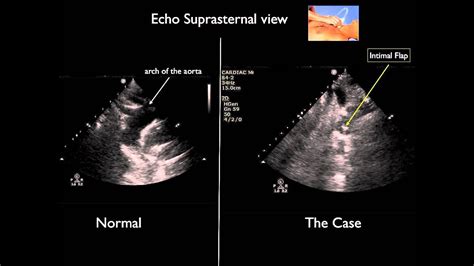 Echo Suprasternal View Youtube