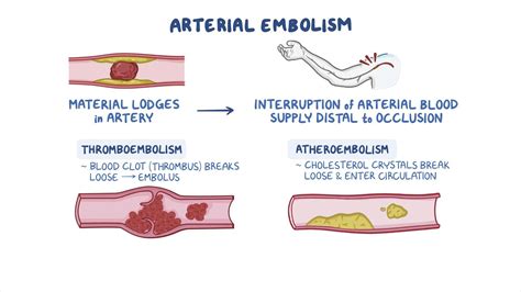 Arterial Embolism Nursing Osmosis Video Library