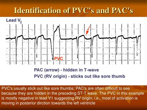 Ppt Electrocardiogram Powerpoint Presentation Free Download Id649219