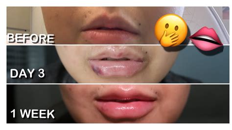 LIP FILLERS WEEK DAILY UPDATE VLOG YouTube