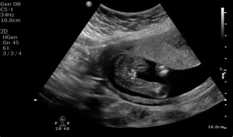 Female Sex Ultrasound Identification Of The Female Fetal Sex At First