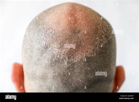 Males Bald Flaky Head With Dandruff Close Up Back View White