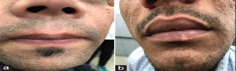 Mucoscopy Of Fordyce S Spots On Lips Indian Dermatology Online Journal