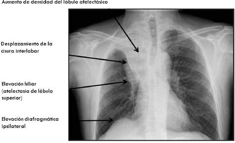 Figure 5 From Revisión De Los Signos Radiológicos De Atelectasia