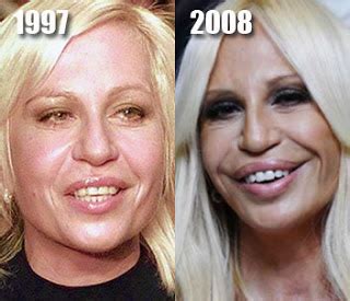 Donatella Versace Plastic Surgery Before And After Nose Job Facelift And Cheek Implants