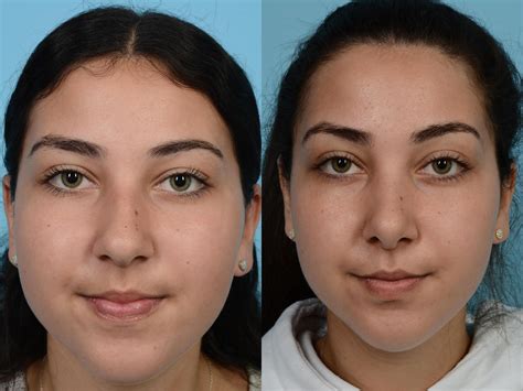 Rhinoplasty Before And After Photos Patient 586 Chicago Il Tlkm