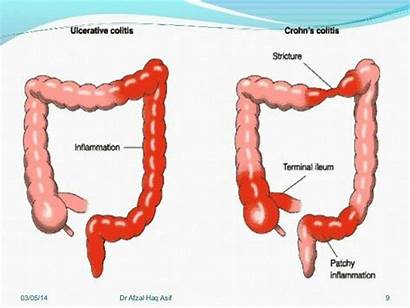 Colitis Ulcerative Disease Crohn Crohns