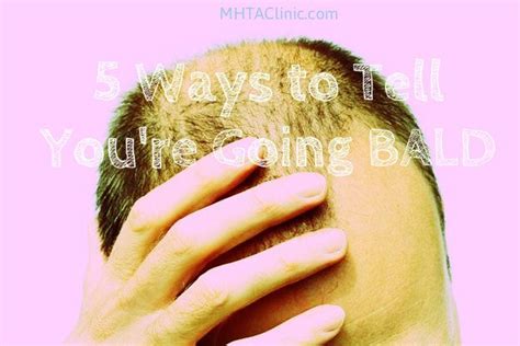5 Ways To Tell Youre Going Bald Hairloss Malepatternbaldness