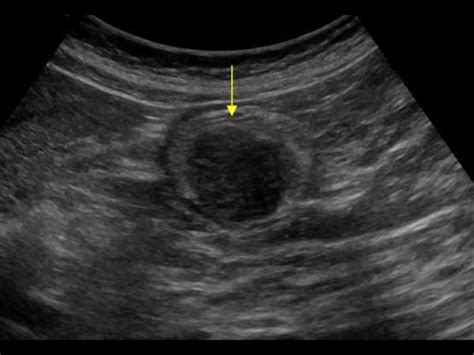 Abdomen And Retroperitoneum 18 Various Intra Abdominal Tumors Case