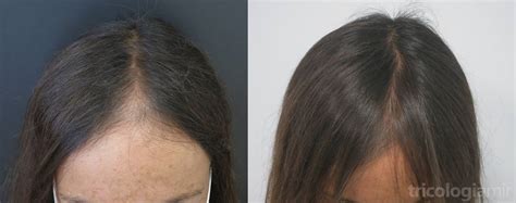 Tratamiento Médico De La Alopecia Androgenética Femenina Faga