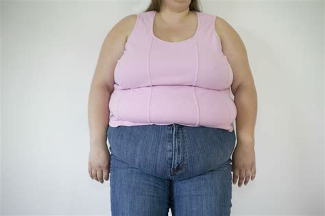 Ожирение 3 Степени Фото telegraph