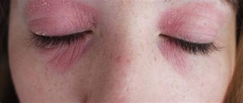 how i got rid of my eye eczema dry skin around eyes eczema on eyelids eye eczema