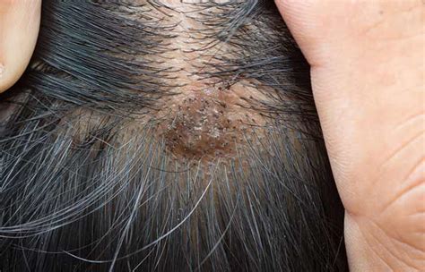 Scalp Problems Causes Symptoms Types And How To Take Care