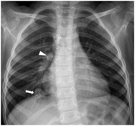 Solitary Round Pulmonary Lesions In The Pediatric Population A