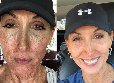 Chemical Peels Scottsdale Aging Acne Wrinkles Brown Spots Melasma