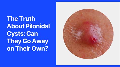 Healed Pilonidal Cyst Scar