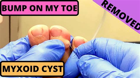 Bump On My Toe Digital Myxoid Cyst How To Remove Part 1 Youtube