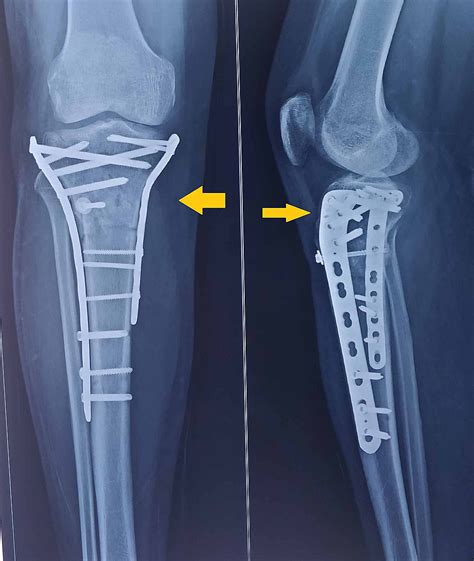 Cureus Tibial Plateau Fracture With Avulsion Fracture Of Tibial