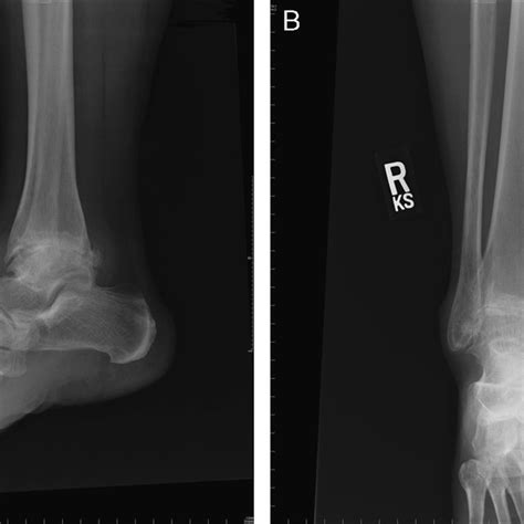 A Lateral Radiograph Showing Characteristic Changes Of Ankle Joint
