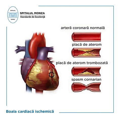 Screening Ul I Diagnosticarea Bolii Cardiace Ischemice Spitalul Monza