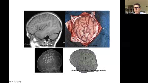 Jorge Gonzalez Rolandic Epilepsy Whats Going On Diagnoses