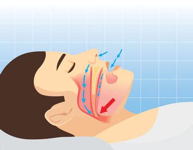 Upper Airway Resistance Syndrome Uars Sleep Apnea Guide