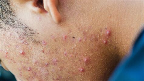 Better Acne Treatments May Be In Our Genes