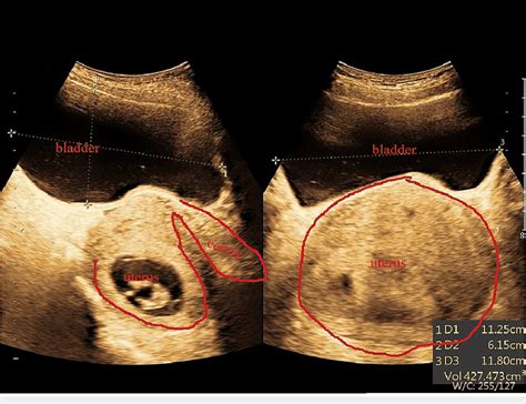 abdominal ultrasound shows a retroverted uterus and a full bladder download scientific diagram