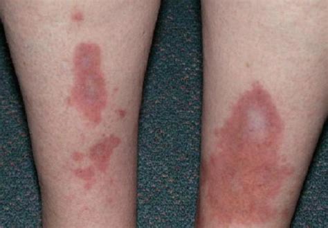 Erythema Nodosum Pictures And Symptoms To Look Out For New Health Advisor